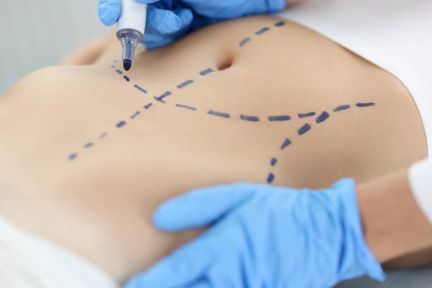 Liposuction Support Tips for Maintaining Body Contouring Success